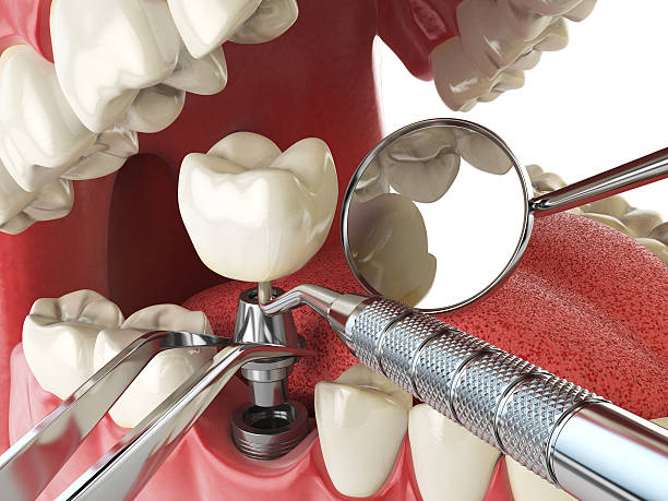Best Emergency Denture Repair in Phelan, CA
